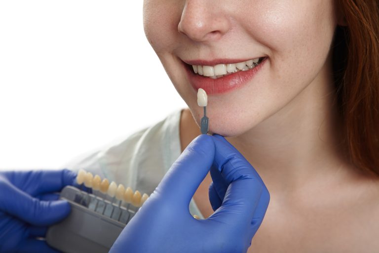Discover the Best Dental Veneers in Budva, Montenegro